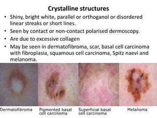 Crystalline structures
• Shiny, bright white, parallel or orthoganol or disordered
linear streaks or short lines.
• Seen by contact or non-contact polarised dermoscopy.
• Are due to excessive collagen
• May be seen in dermatofibroma, scar, basal cell carcinoma
with fibroplasia, squamous cell carcinoma, Spitz naevi and
melanoma.

Dermatofibroma

Pigmented basal
cell carcinoma

Superficial basal
cell carcinoma

Melanoma

 