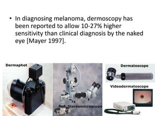• In diagnosing melanoma, dermoscopy has
been reported to allow 10-27% higher
sensitivity than clinical diagnosis by the naked
eye [Mayer 1997].

Dermaphot

Dermatoscope

Videodermatoscope

Stereomicroscope

 