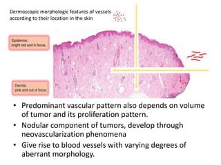 Dermoscopic morphologic features of vessels
according to their location in the skin

• Predominant vascular pattern also depends on volume
of tumor and its proliferation pattern.
• Nodular component of tumors, develop through
neovascularization phenomena
• Give rise to blood vessels with varying degrees of
aberrant morphology.

 