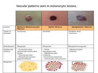 Vascular patterns seen in melanocytic lesions.

 