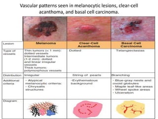 Vascular patterns seen in melanocytic lesions, clear-cell
acanthoma, and basal cell carcinoma.

 