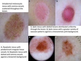 Intradermal melanocytic
nevus with comma vessels
scattered throughout the
lesion.

A, Spitz nevus with dotted lesions distributed uniformly
through the lesion. B, Spitz nevus with a greater variety of
vascular patterns against a characteristic pink background.

A, Dysplastic nevus with
predominant irregular linear
vessels. B, Dysplastic nevus with
dotted and comma vessels
against a brownish background

 