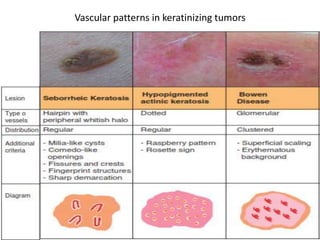 Vascular patterns in keratinizing tumors

 