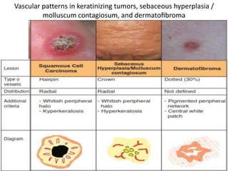 Vascular patterns in keratinizing tumors, sebaceous hyperplasia /
molluscum contagiosum, and dermatoﬁbroma

 