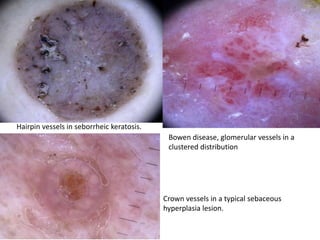 Hairpin vessels in seborrheic keratosis.

Bowen disease, glomerular vessels in a
clustered distribution

Crown vessels in a typical sebaceous
hyperplasia lesion.

 