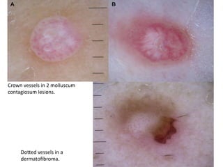 Crown vessels in 2 molluscum
contagiosum lesions.

Dotted vessels in a
dermatoﬁbroma.

 