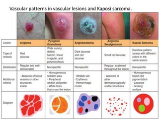 Vascular patterns in vascular lesions and Kaposi sarcoma.

 