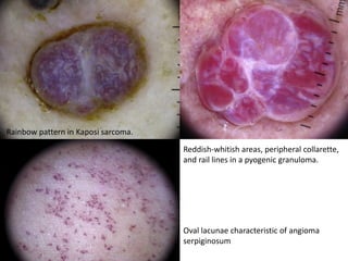 Rainbow pattern in Kaposi sarcoma.

Reddish-whitish areas, peripheral collarette,
and rail lines in a pyogenic granuloma.

Oval lacunae characteristic of angioma
serpiginosum

 