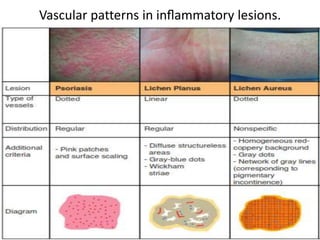 Vascular patterns in inﬂammatory lesions.

 
