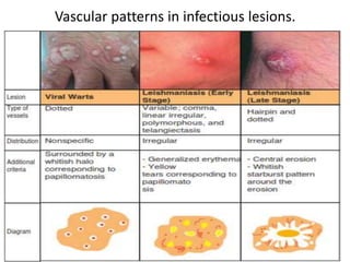 Vascular patterns in infectious lesions.

 