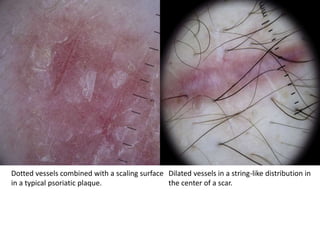 Dotted vessels combined with a scaling surface Dilated vessels in a string-like distribution in
in a typical psoriatic plaque.
the center of a scar.

 