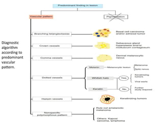 Diagnostic
algorithm
according to
predominant
vascular
pattern.

 