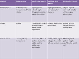 Diagnosis

Global Patterns

Specific Local Features Additional Local
Features

Confounding Features

Combined nevus

Multicomponent,
Typical pigment
Hypopigmented areas,
homogeneous, globular, network, regular
exophytic papillary
reticular
dots/globules, localized structures
regular pigmentation

Atypical pigment
network, localized or
diffuse irregular
pigmentation

Lentigo

Reticular

Typical pigment network Milia-like cysts, regular
or pseudonetwork,
dots/globules
regular diffuse
pigmentation

Atypical pigment
network, irregular
pigmentation

Vascular lesions

Lacunar, globular,
homogeneous

Red lacunas, diffuse or
localized structureless
reddish-black to
reddish-blue
pigmentation

Parallel pattern, regular Multicomponent
dots/globules, whitish- pattern; irregular
yellowish keratotic areas dots/globules, whitish
veil

 