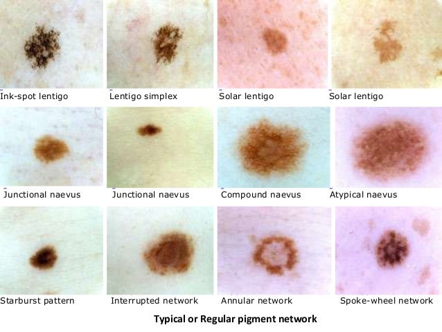 Benign melanocytic nevus - Wikipedia