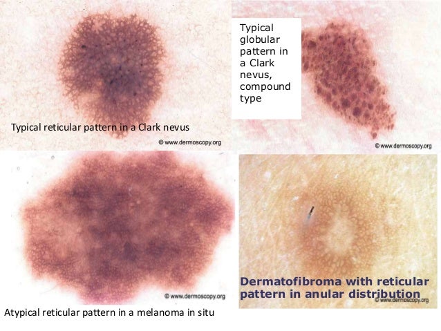 Reed nevus (pigmented spindle-cell nevus): a report of ...
