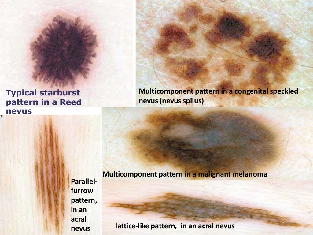 Dermoscopy pigment vs vascular