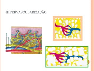 HIPERVASCULARIZAÇÃO
 