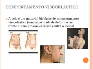 COMPORTAMENTO VISCOELÁSTICO
 A pele é um material biológico de comportamento
viscoelástico (com capacidade de deformar-se
frente a uma pressão exercida contra o tecido)
 