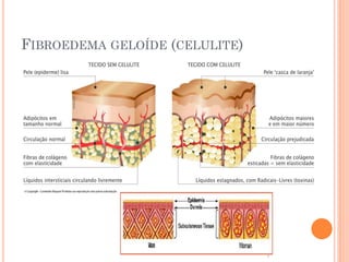 FIBROEDEMA GELOÍDE (CELULITE)
 