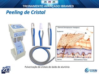 TREINAMENTO AVANÇADO IBRAMED
Pulverização de cristais de óxido de alumínio
Peeling de Cristal
 
