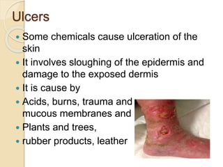 Ulcers
 Some chemicals cause ulceration of the
skin
 It involves sloughing of the epidermis and
damage to the exposed dermis
 It is cause by
 Acids, burns, trauma and can occur on
mucous membranes and skin
 Plants and trees,
 rubber products, leather
 