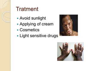 Tratment
 Avoid sunlight
 Applying of cream
 Cosmetics
 Light sensitive drugs
 