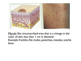 Macule: ﬂat circumscribed area that is a change in the
color of skin, less than 1 cm in diameter
Example: freckles, ﬂat moles, petechiae, measles, scarlet
fever
 