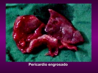Pericardio engrosado   