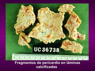 Fragmentos de pericardio en láminas calcificadas   