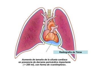 Aumento de tamaño de la silueta cardíaca  en presencia de derrame pericárdico importante  ( > 250 ml), con forma de «cantimplora».   Radiografía de Tórax 