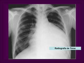 Radiografía de Tórax 