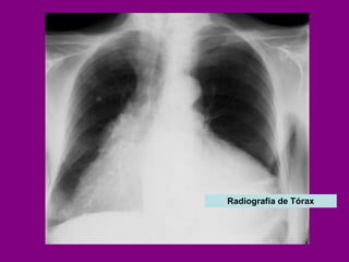 Radiografía de Tórax 