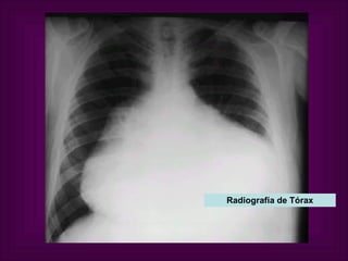 Radiografía de Tórax 