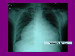 Radiografía de Tórax 