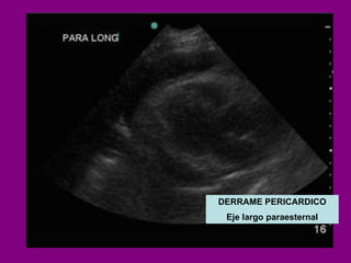 DERRAME PERICARDICO Eje largo paraesternal 