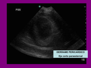 DERRAME PERICARDICO Eje corto paraesternal 