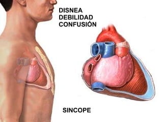 SINCOPE DISNEA DEBILIDAD CONFUSIÓN 