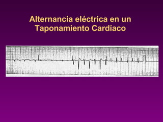 Alternancia eléctrica en un Taponamiento Cardíaco 