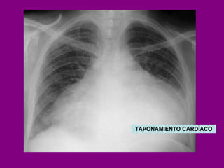 TAPONAMIENTO CARDÍACO 