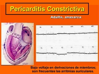 Bajo voltaje en derivaciones de miembros; son frecuentes las arritmias auriculares.   Pericarditis Constrictiva 