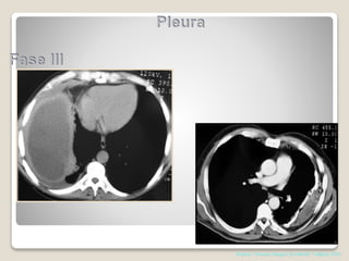 Pearson. Thoracic Surgery,Texxtbokk 7 edition; 2014
 