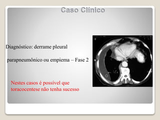 Diagnóstico: derrame pleural
parapneumônico ou empiema – Fase 2
Nestes casos é possível que
toracocentese não tenha sucesso
 