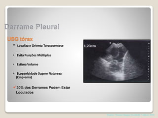 USG tórax
• Localiza e Orienta Toracocentese
• Evita Punções Múltiplas
• Estima Volume
• Ecogenicidade Sugere Natureza
(Empiema)
30% dos Derrames Podem Estar
Loculados
Pearson. Thoracic Surgery,Texxtbokk 7 edition; 2014
 