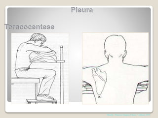 Shields. Thoracic Surgery,Clinics 7 edition; 2015
 