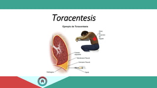 Toracentesis
 