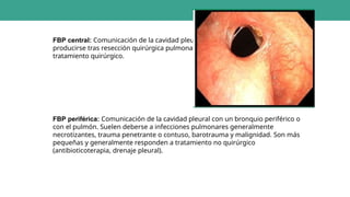 FBP central: Comunicación de la cavidad pleural con un bronquio central. Suelen
producirse tras resección quirúrgica pulmonar. Suelen ser grandes y requerir
tratamiento quirúrgico.
FBP periférica: Comunicación de la cavidad pleural con un bronquio periférico o
con el pulmón. Suelen deberse a infecciones pulmonares generalmente
necrotizantes, trauma penetrante o contuso, barotrauma y malignidad. Son más
pequeñas y generalmente responden a tratamiento no quirúrgico
(antibioticoterapia, drenaje pleural).
 