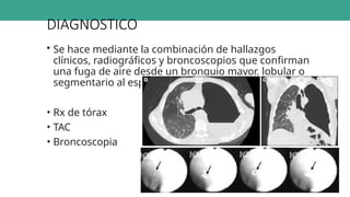 DIAGNOSTICO
• Se hace mediante la combinación de hallazgos
clínicos, radiográficos y broncoscopios que confirman
una fuga de aire desde un bronquio mayor, lobular o
segmentario al espacio pleural
• Rx de tórax
• TAC
• Broncoscopia
 