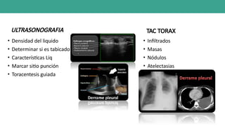 ULTRASONOGRAFIA
• Densidad del liquido
• Determinar si es tabicado
• Características Liq
• Marcar sitio punción
• Toracentesis guiada
TAC TORAX
• Infiltrados
• Masas
• Nódulos
• Atelectasias
 