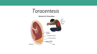 Toracentesis
 
