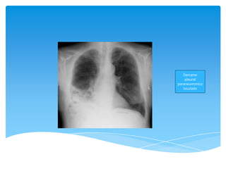 Derrame
pleural
paraneumonico
loculado
 